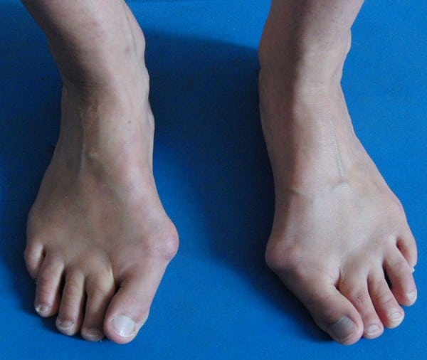 La bobologie - Total Feet